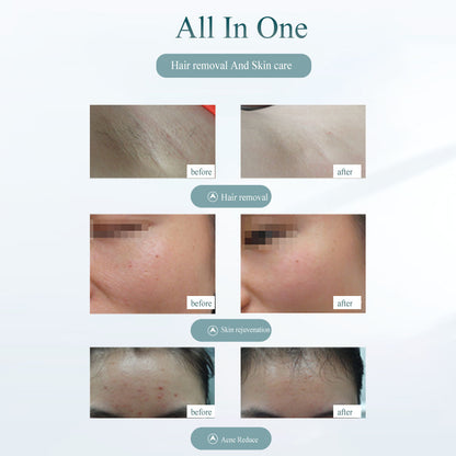 Laser Hair Removal Device - Painless Hair Removal Tool